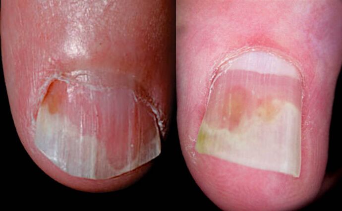 Nail Psoriasis On The Hands And Feet Causes Diagnosis And Symptoms With A Photo Official 6821